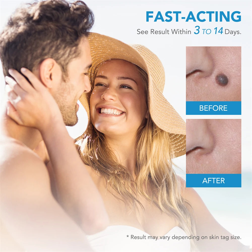2 IN 1 Auto Micro Skin Tag Remover Kit for Home Use - Hart4Savings Hart4Savings Orange / CHINA Hart 4 Savings Self Care