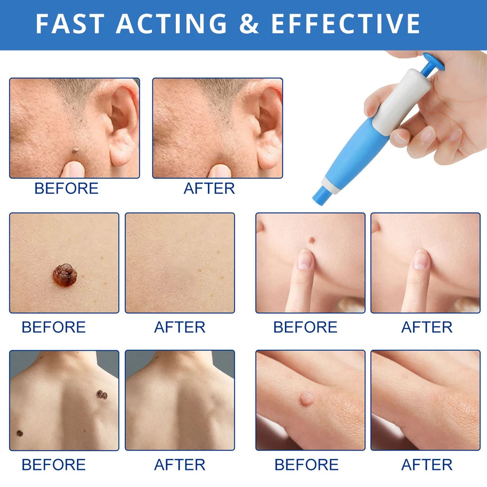 2 IN 1 Auto Micro Skin Tag Remover Kit for Home Use - Hart4Savings Hart4Savings Orange / CHINA Hart 4 Savings Self Care