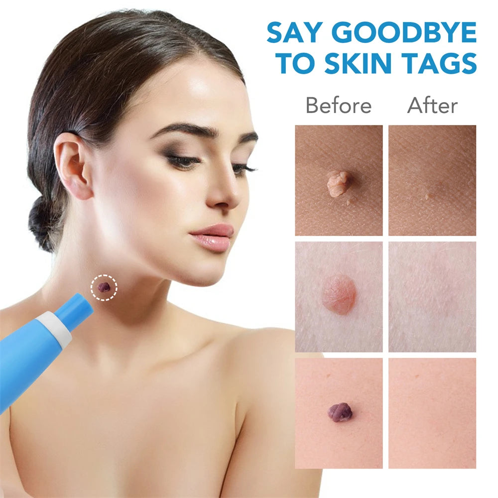 2 IN 1 Auto Micro Skin Tag Remover Kit for Home Use - Hart4Savings Hart4Savings Orange / CHINA Hart 4 Savings Self Care