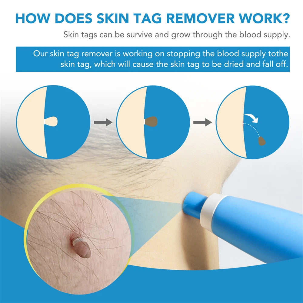 2 IN 1 Auto Micro Skin Tag Remover Kit for Home Use - Hart4Savings Hart4Savings Orange / CHINA Hart 4 Savings Self Care