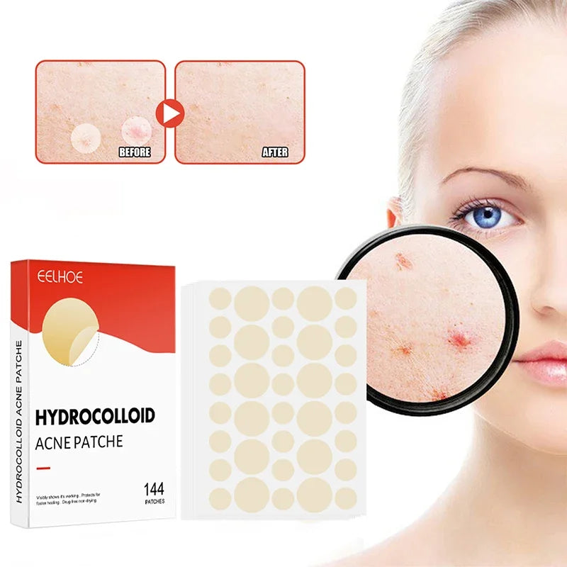 144pcs Invisible Professional Healing Pimple Patches 2 Sizes - Hart4Savings Hart4Savings 144pcs Hart 4 Savings